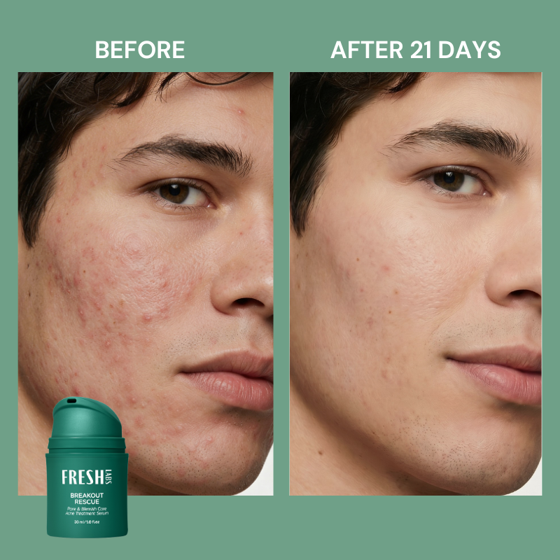 Breakout Rescue Acne Serum